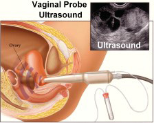 vaginal ultrasound